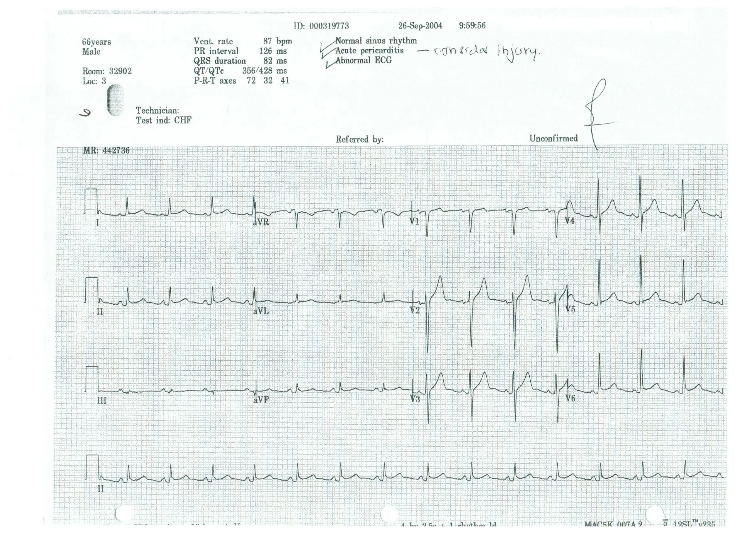    Normal sinus rhythm      Acute pericarditis---consider injury      Abnormal ECG   