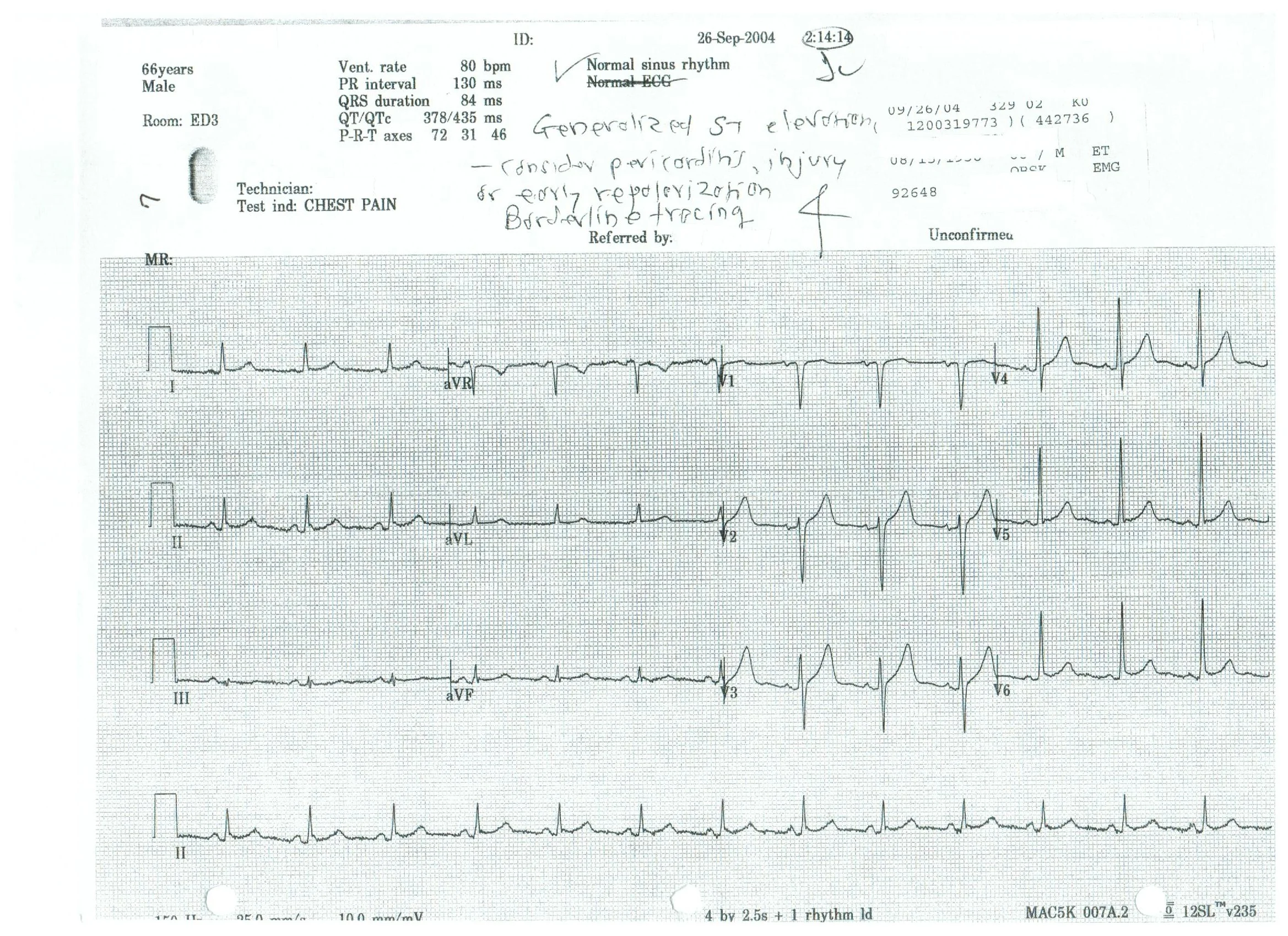    Normal sinus rhythm      Generalized ST elevation      Consider pericarditis, injury, or early repolarization      Borderline tracing   