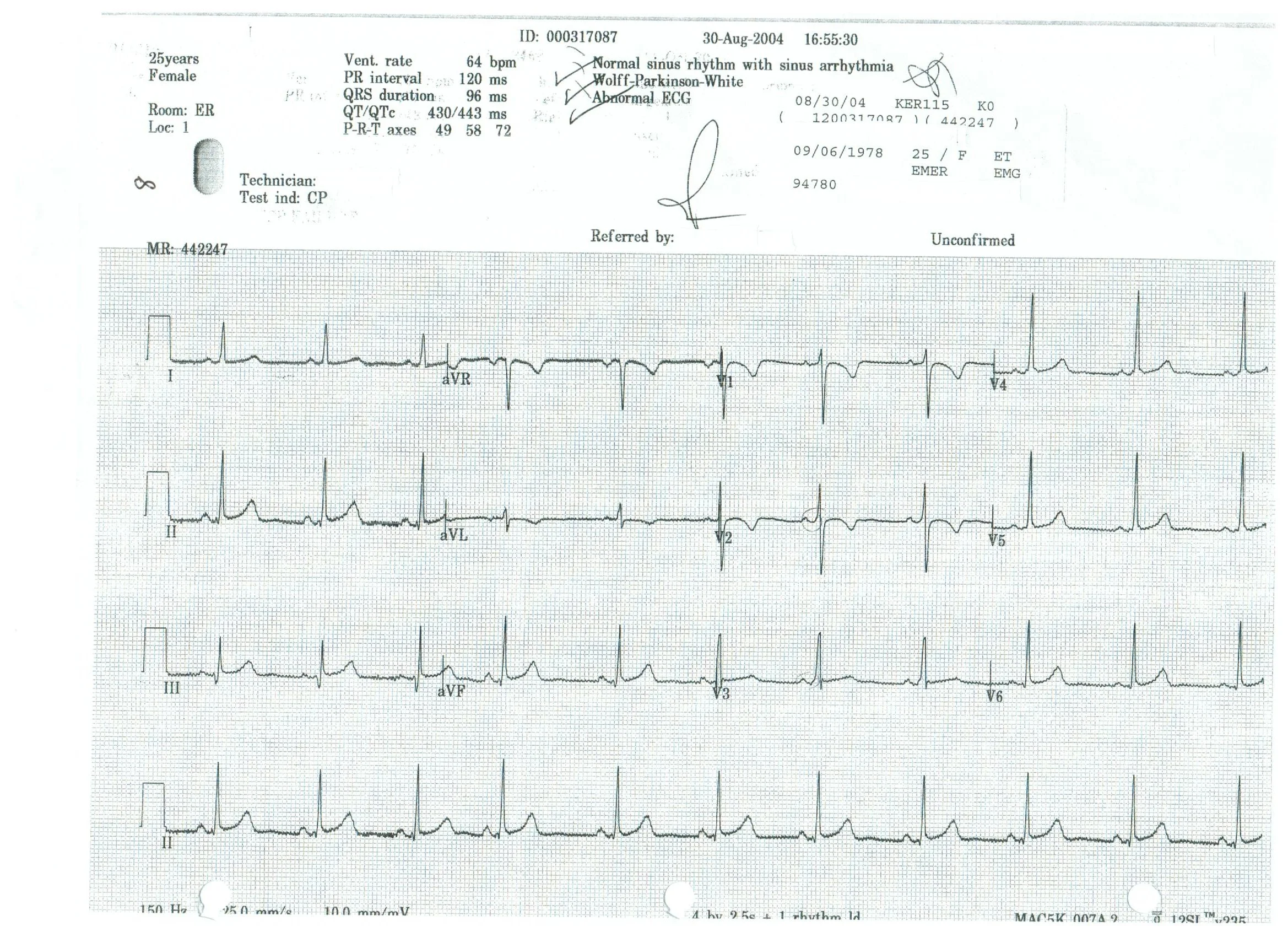    Normal sinus rhythm with sinus arrhythmia      Wolff-Parkinson-White      Abnormal ECG   