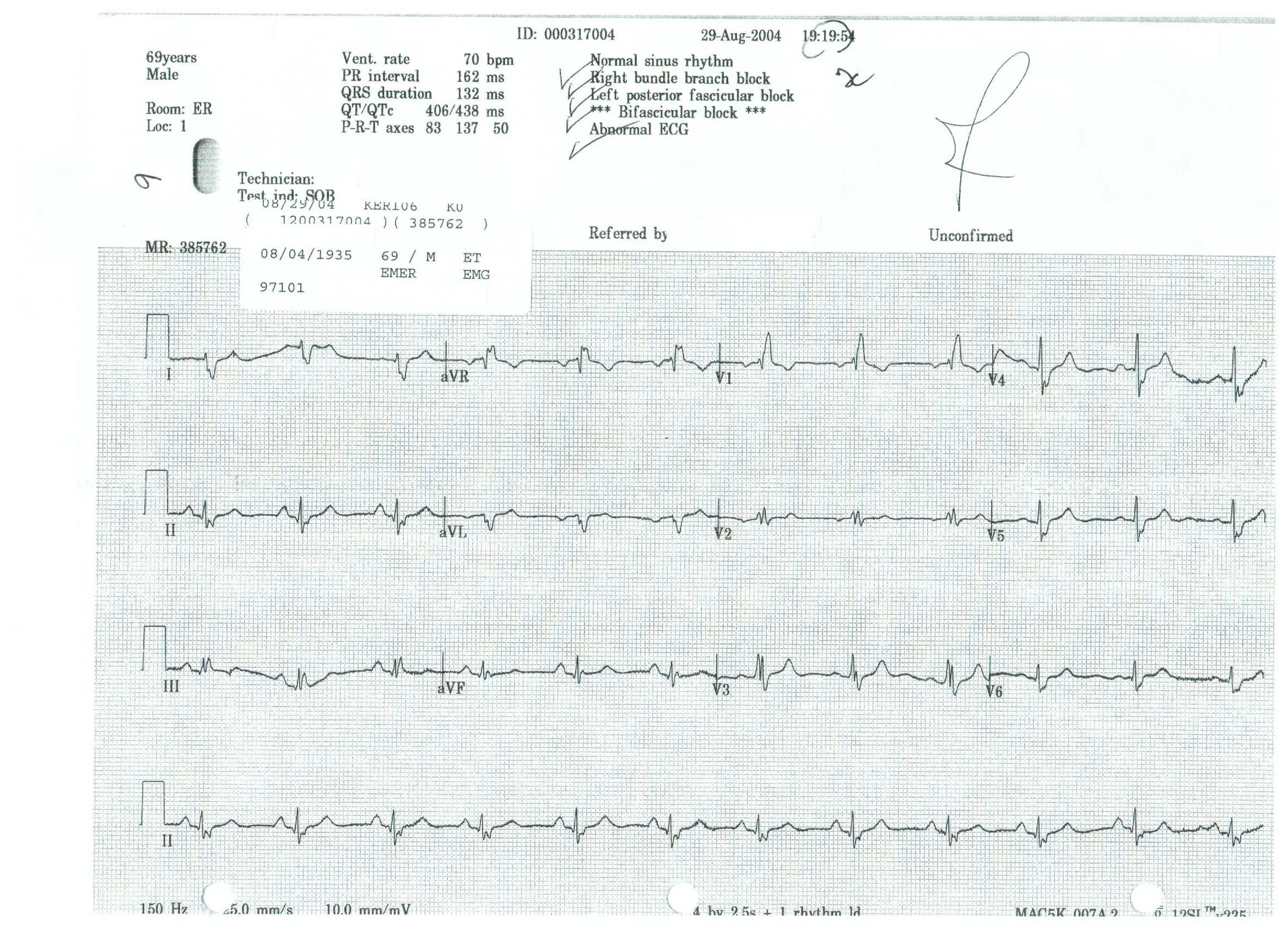    Normal sinus rhythm      Right bundle branch block      Left posterior fascicular block      Bifascicular block      Abnormal ECG   
