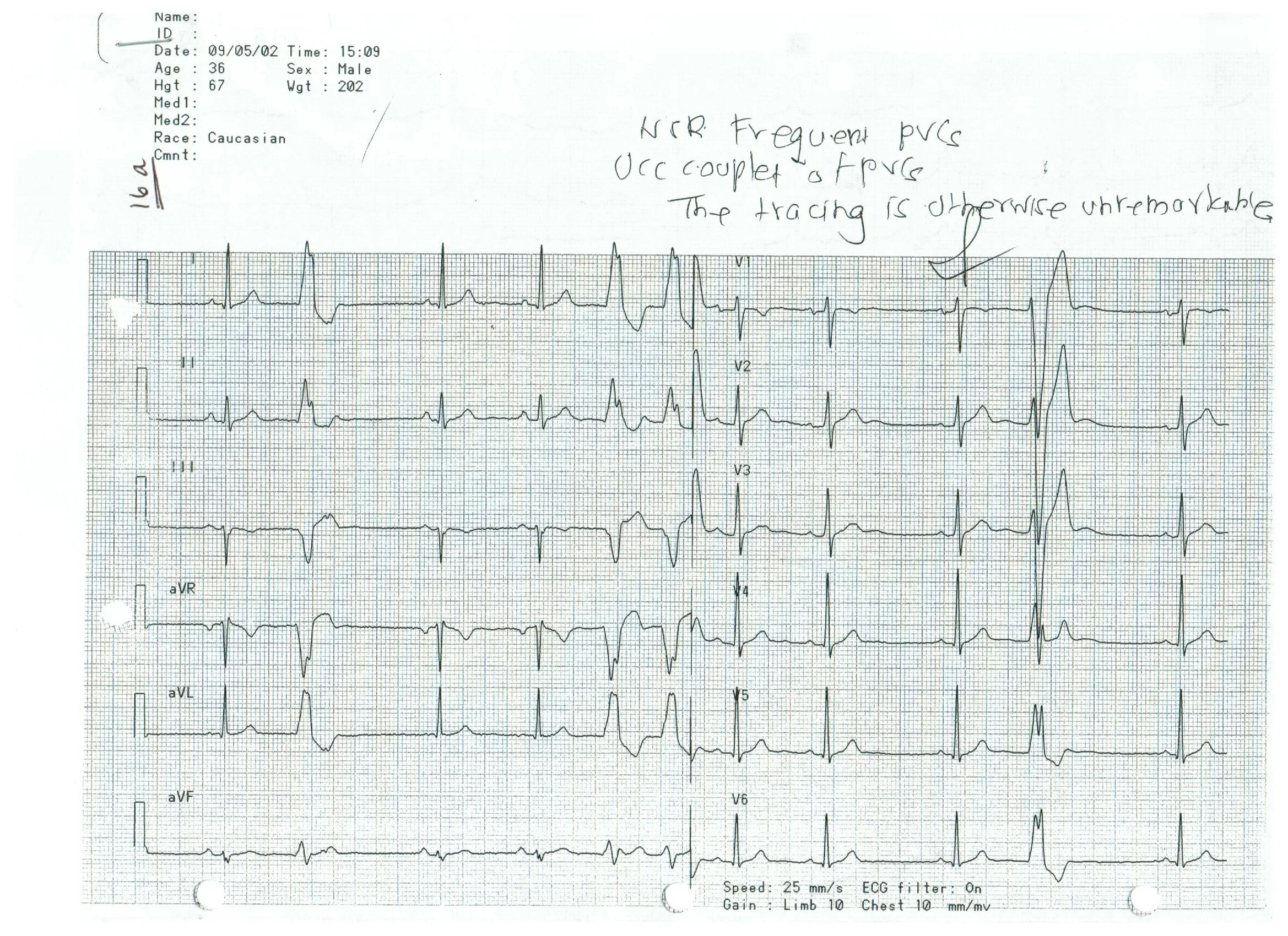 EKG 16a.jpeg