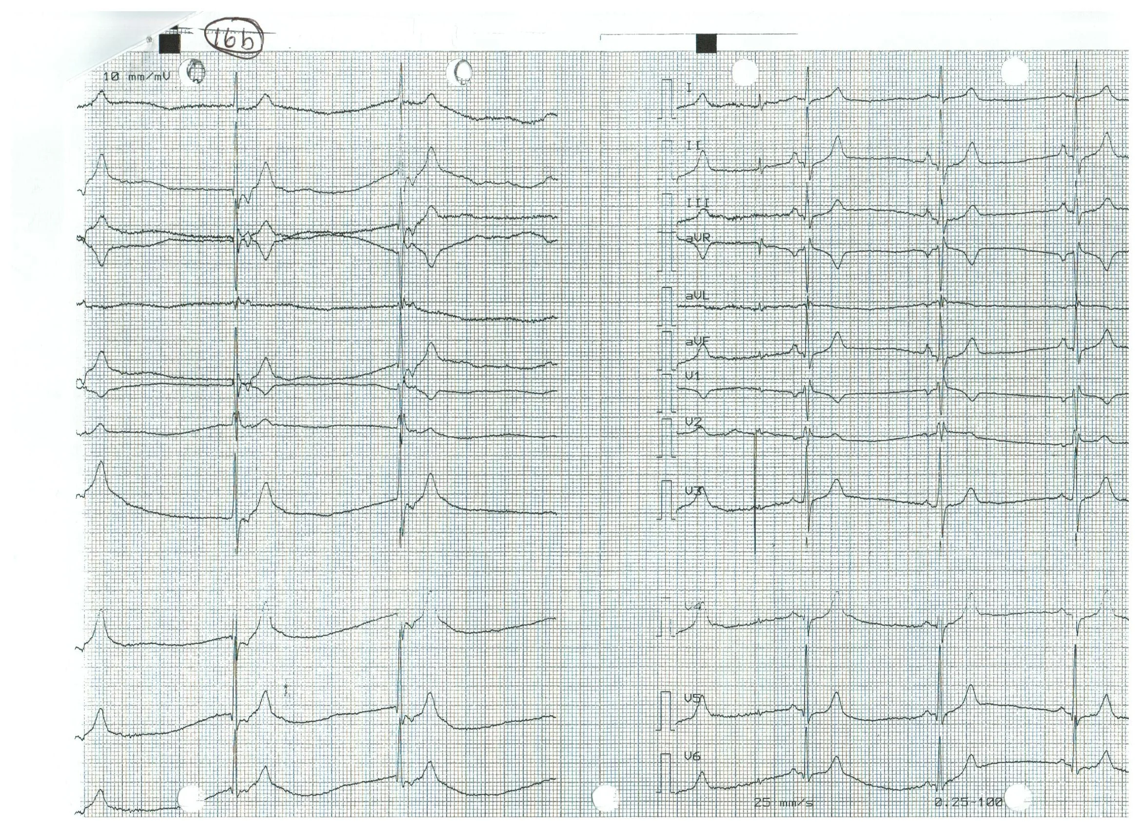 EKG 16b.jpeg
