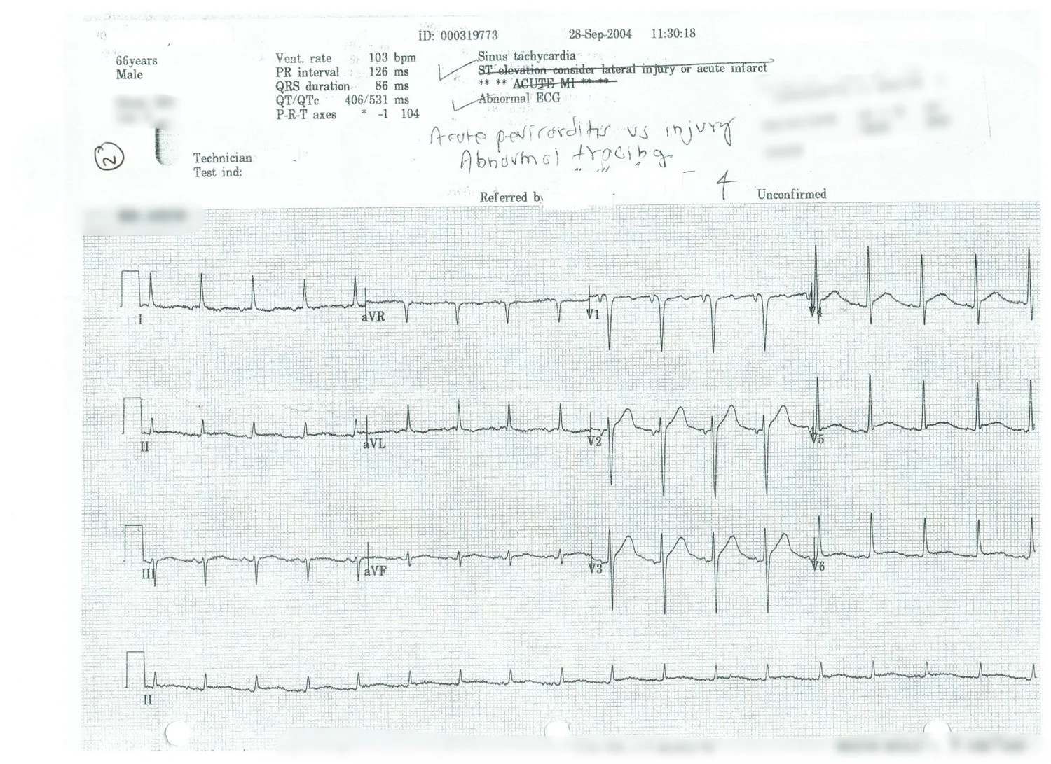    Sinus Tachycardia      Acute Pericarditis vs Injury      Abnormal Tracing   