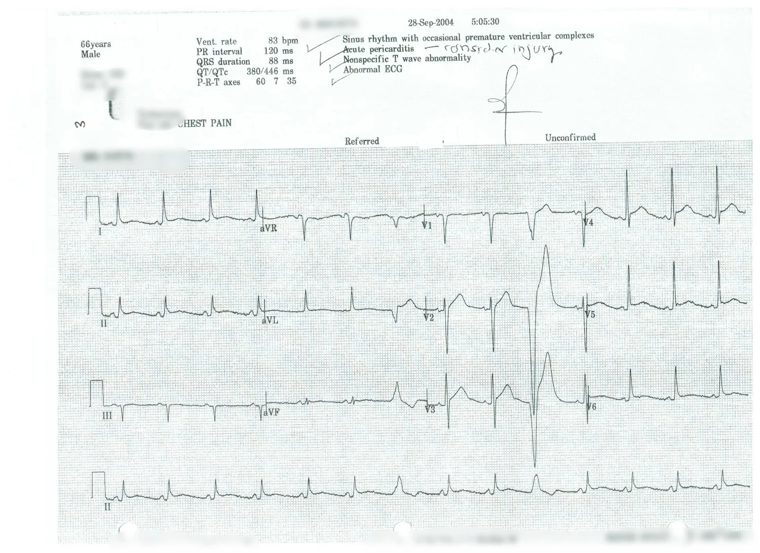    Sinus rhythm with occasion Premature Ventricular Complexes      Acute Pericarditis---consider injury      Nonspecific T wave abnormality      Abnormal ECG   