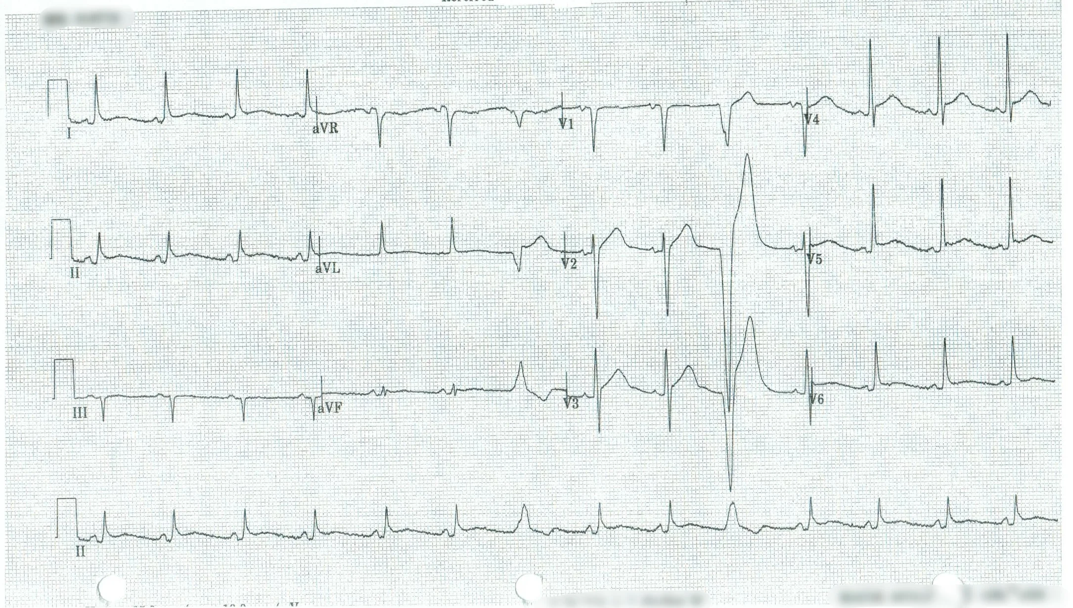 EKG 3.jpeg