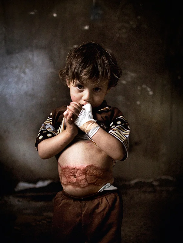 Farah, 3 years old, whose body was burned by phosphourus during operation Cast Lead, where Israel attacked the Gaza Strip with phosphorus bombs. Farah survived miraculously as they carved the burning skin off her body. But her mother died due to recurring infections of the wounds, 3 months after the war. Today Farah is cared for by her grandmother. 