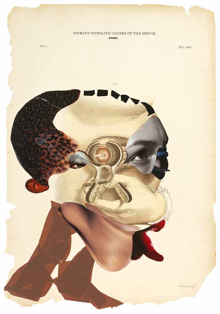 Primary syphilitic ulcers of the cervix, 2006, waarover het in een vorig artikel op Ik kijk kunst ging
