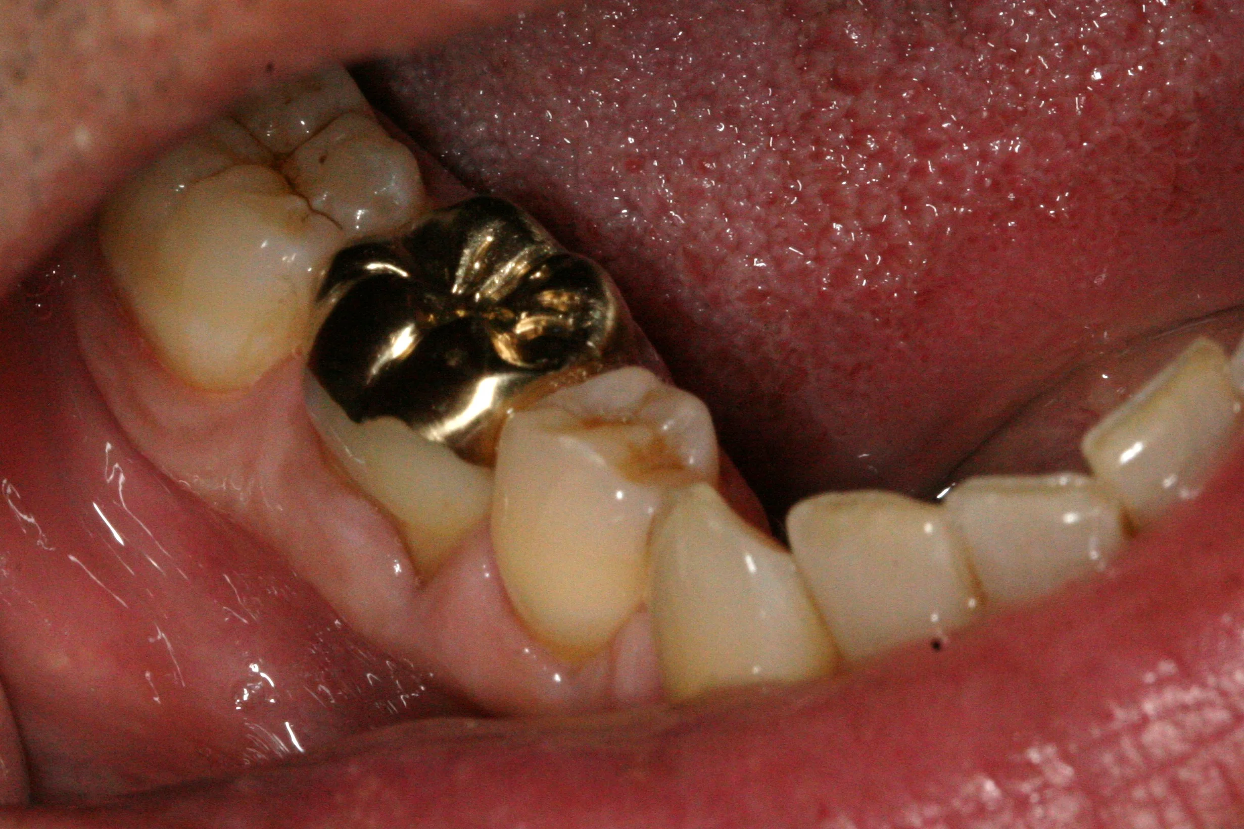 Crowns CJN Dentistry Mission St Dentist Since 1986