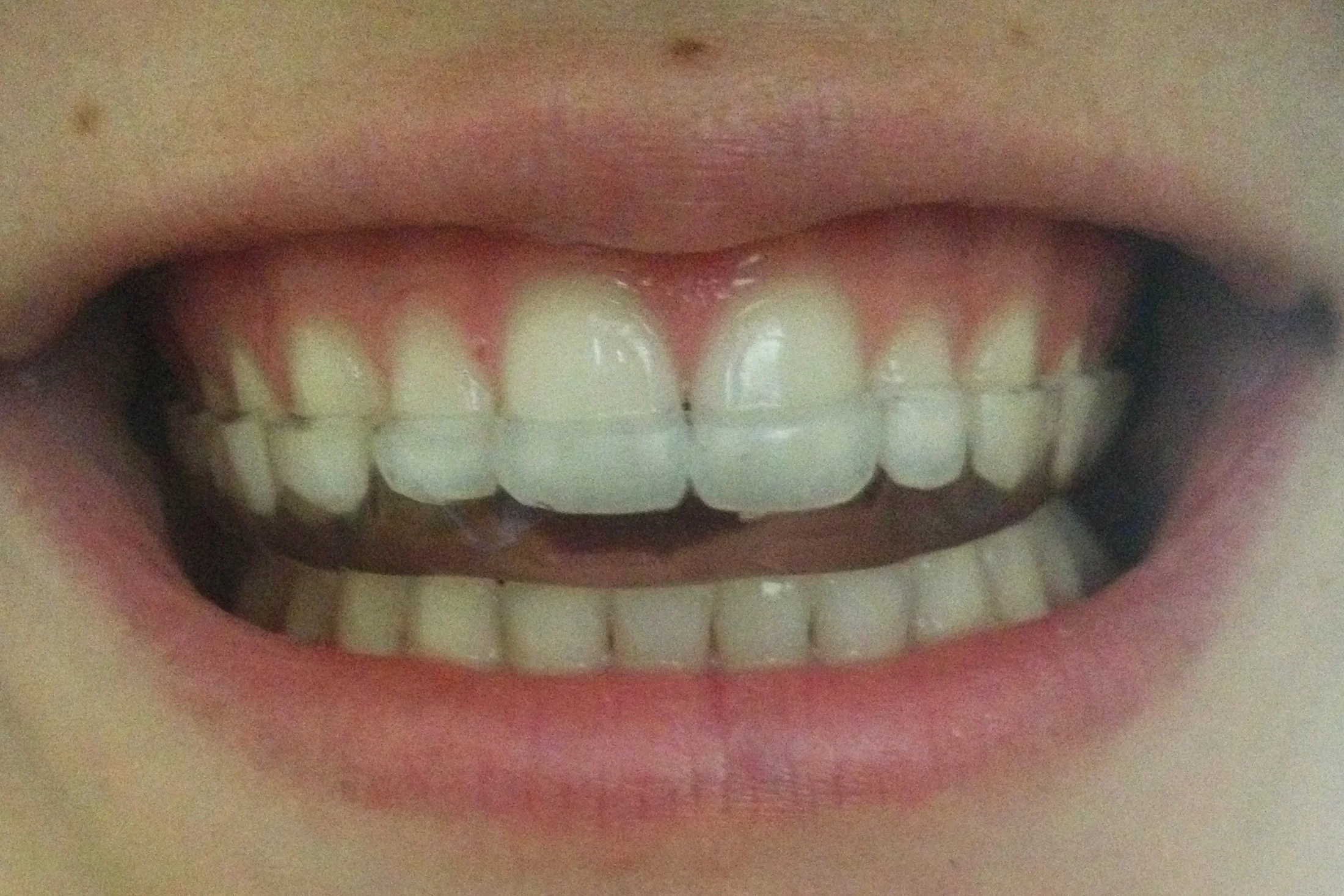 TMJ treatment/ Bruxism splint — CJN Dentistry, mission st. dentist