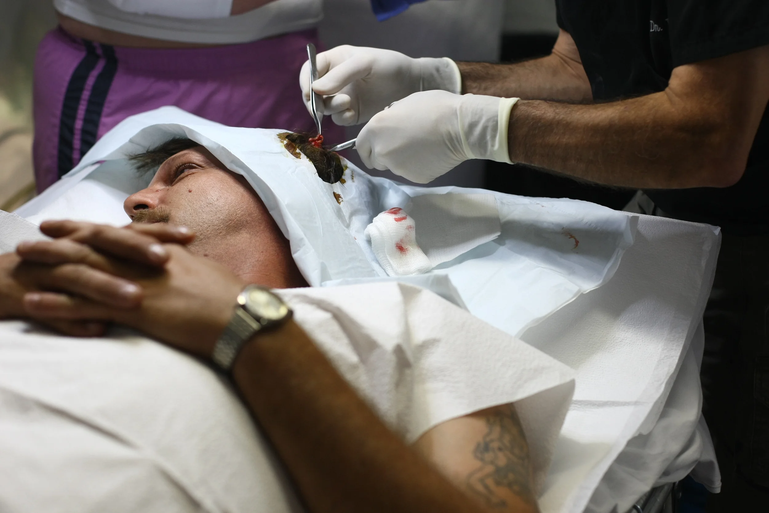  &nbsp;Dr. Vincent Voci removes a small ball-sized cyst growing under Stephen Wright's scalp with medical assistance from Tammy Love. Wright, of Coeburn, VA, says he finally decided to come to RAM for the first time after girlfriend Tasha Mullins ins