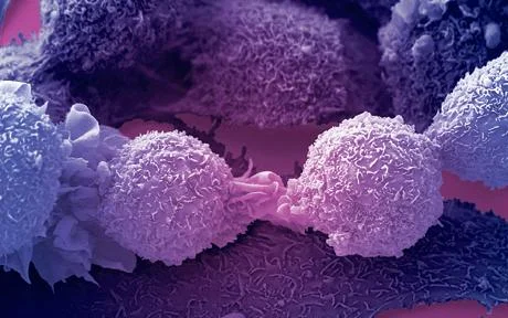 Cancer cells under a microscope, Telegraph, UK (2009)