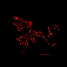 Chromogranin Stain Type 1 Diabetes Islet: "What is most interesting is to look at stains highlighting chromogranin (red) and insulin (green) - significantly less hormone producing and insulin secreting (beta) cells in type 1 diabetes islet." (Dr Anneliese Flatt)