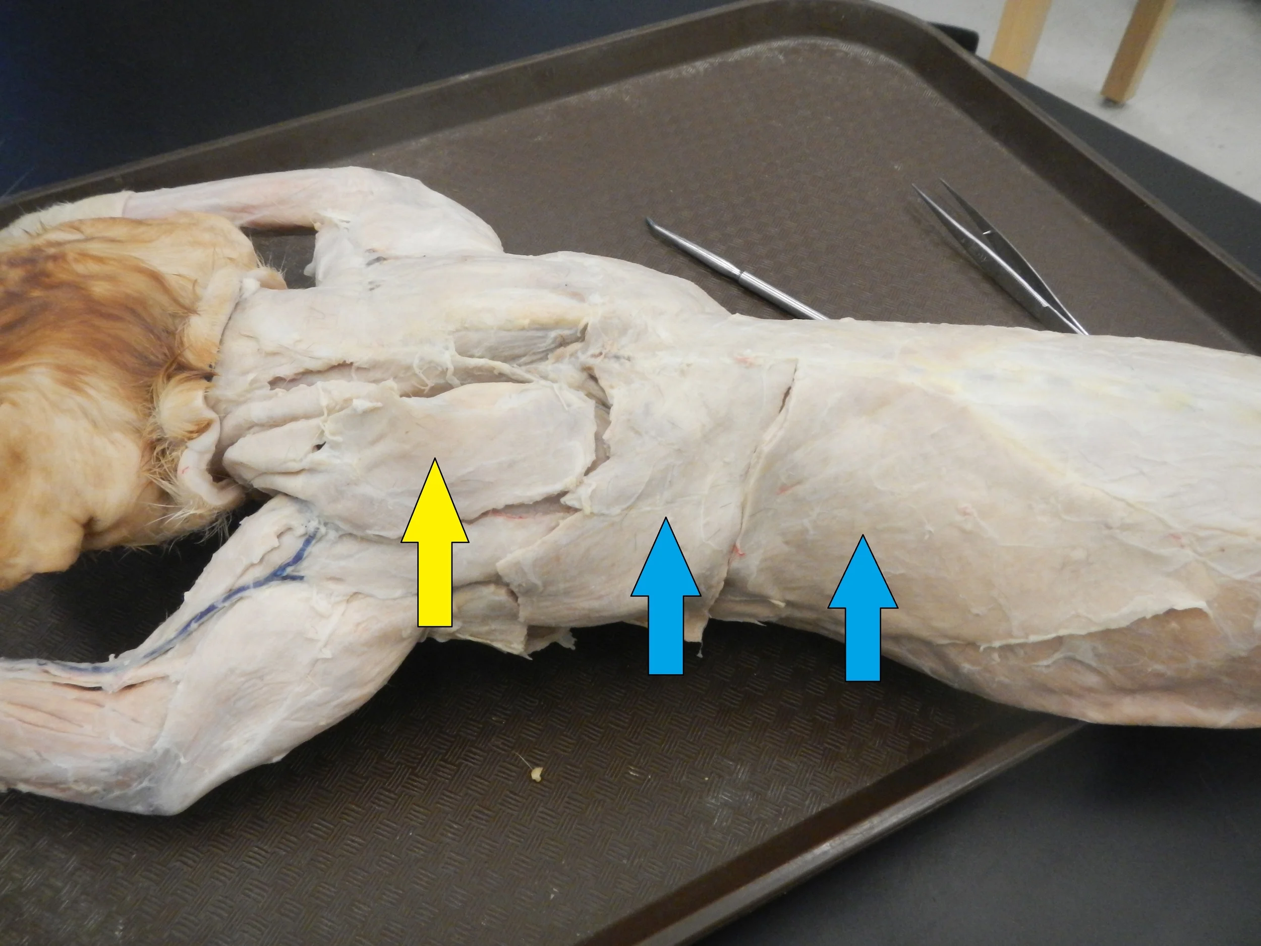 Blue: Latissimus Dorsi - Not Reflected Yellow: Trapezius - Not Reflected
