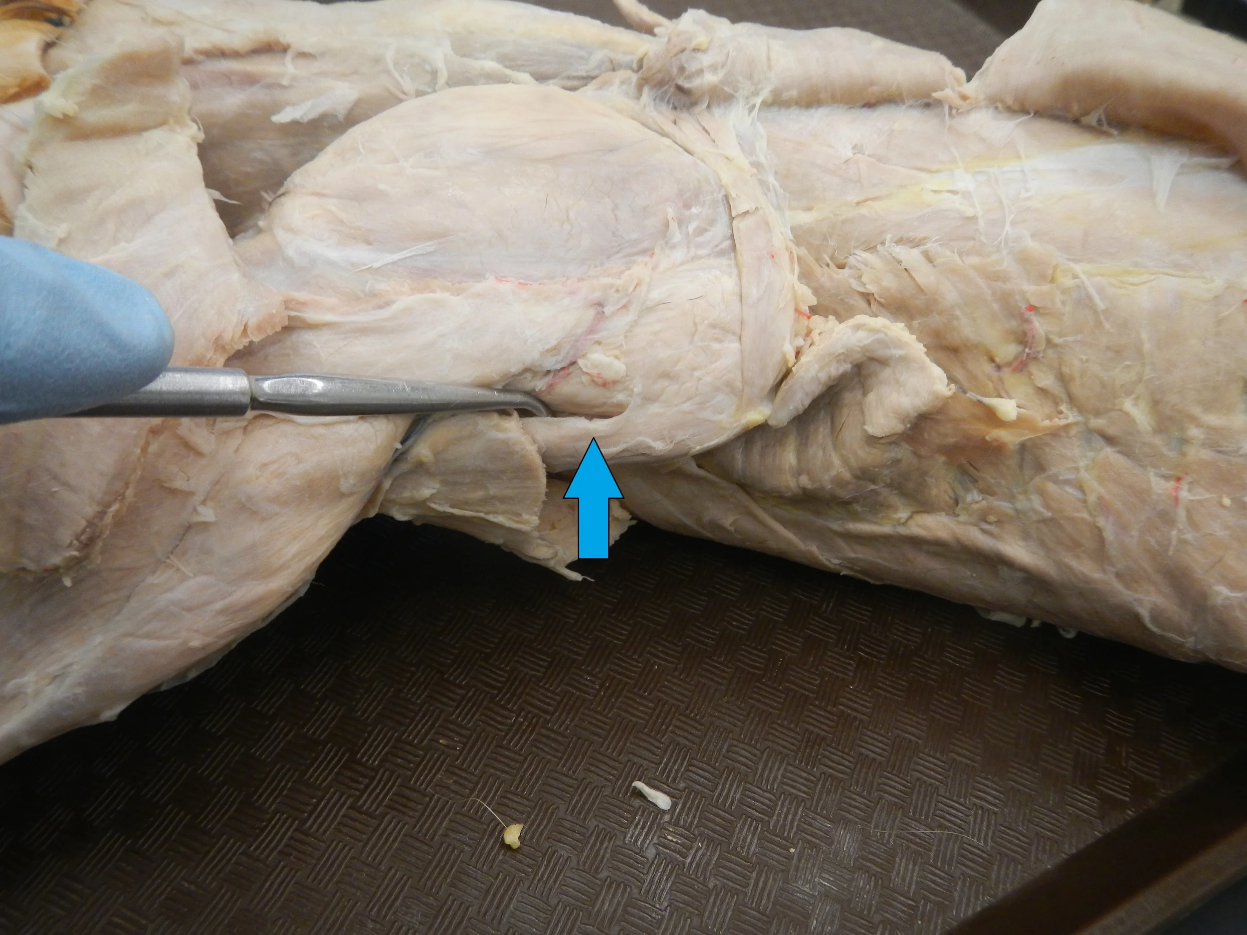 Teres Major O -
Lateral border/inferior angle of scapula I -
Bicipital Groove of Humerus F -
Shoulder extension, assists in adduction and medial rotation of humerus
(internal rotation)