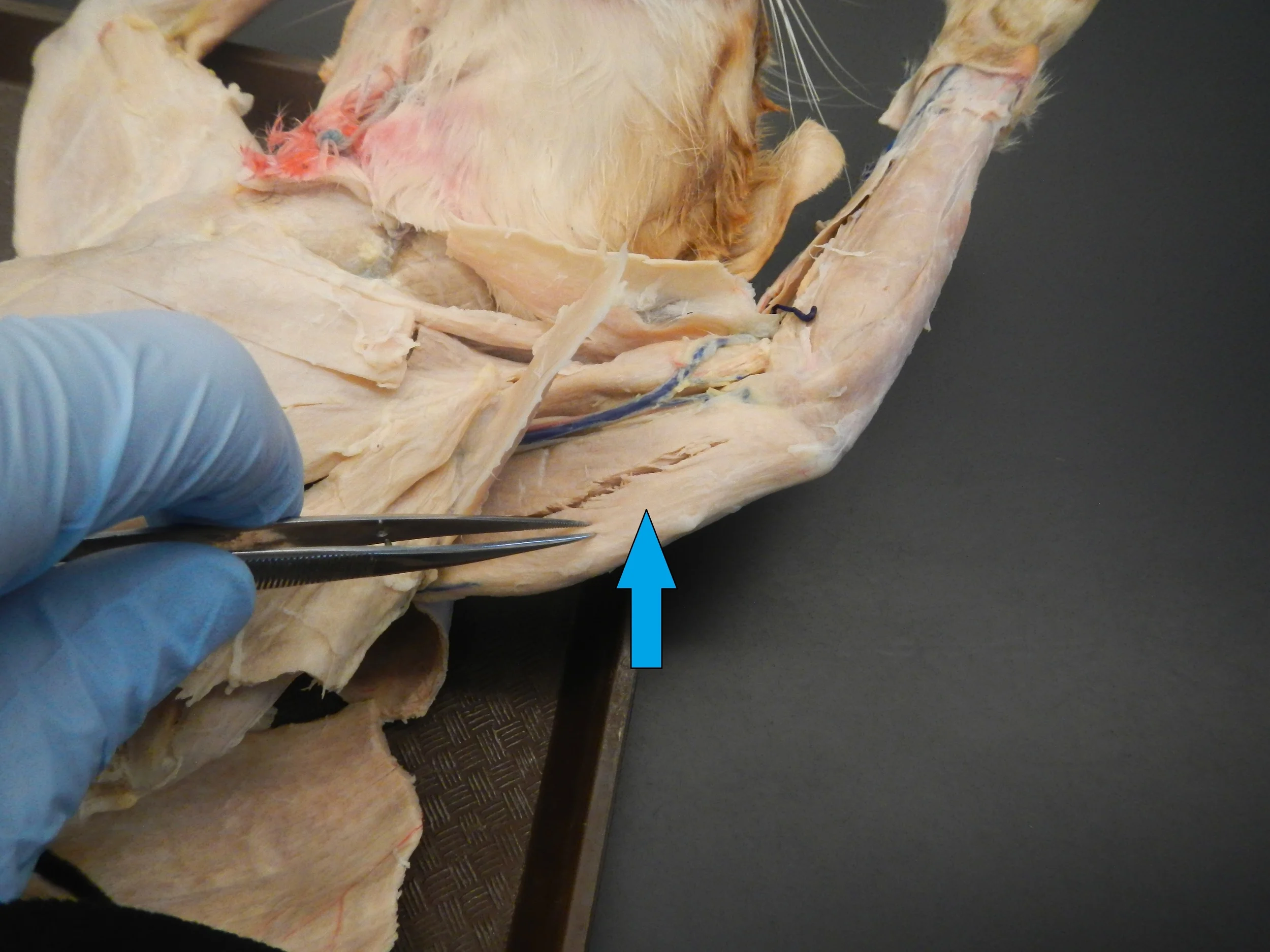 Triceps - Long Head Anterior View O -
Infraglenoid tubercle of scapula I -
Olecranon process of ulna F -
Shoulder extension and elbow extension