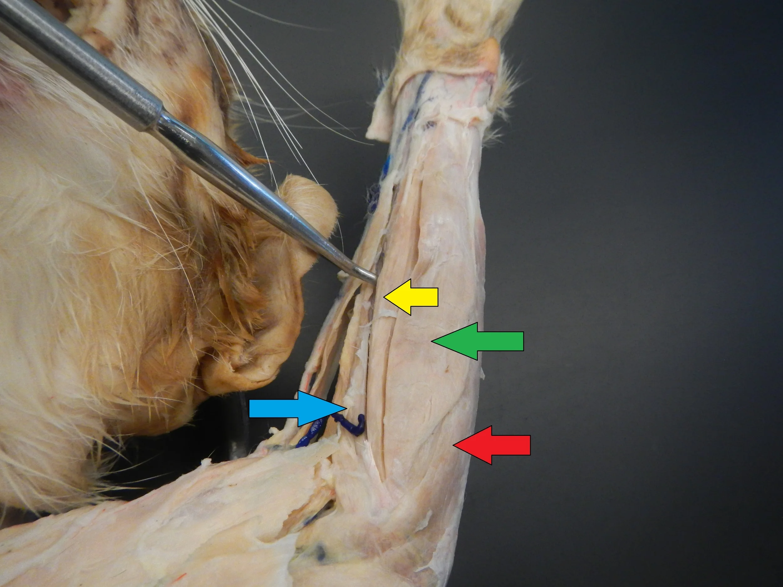 Forearm Flexors Blue: Pronator Teres Yellow: Flexor Carpi Radialis Green: Palmaris Longus Red: Flexor Carpi Ulnaris