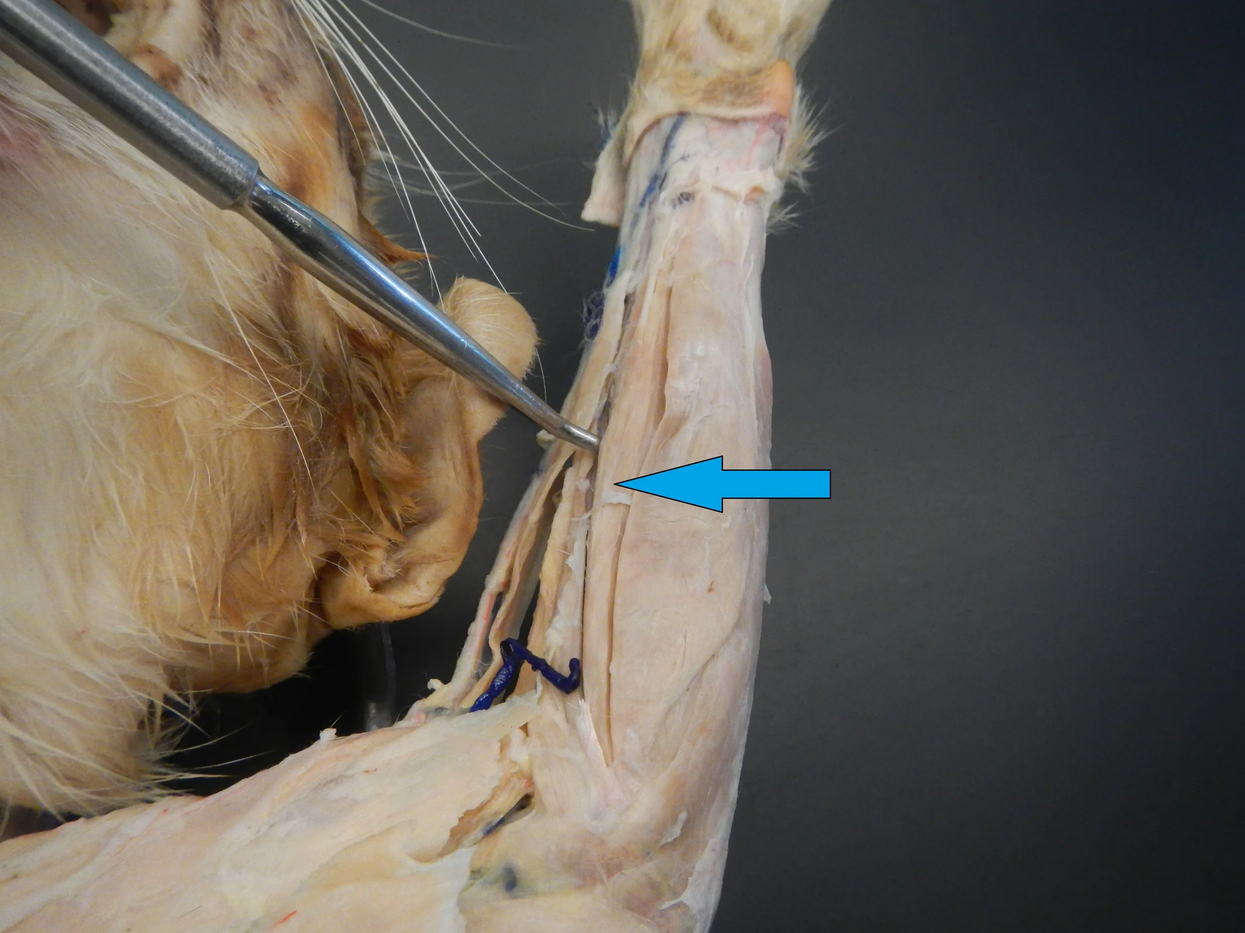 Flexor Carpi Radialis O -
Medial epicondyle of humerus I -
2nd and 3rd metacarpals, passes under flexor retinaculum F -
Elbow flexion, wrist flexion and abduction