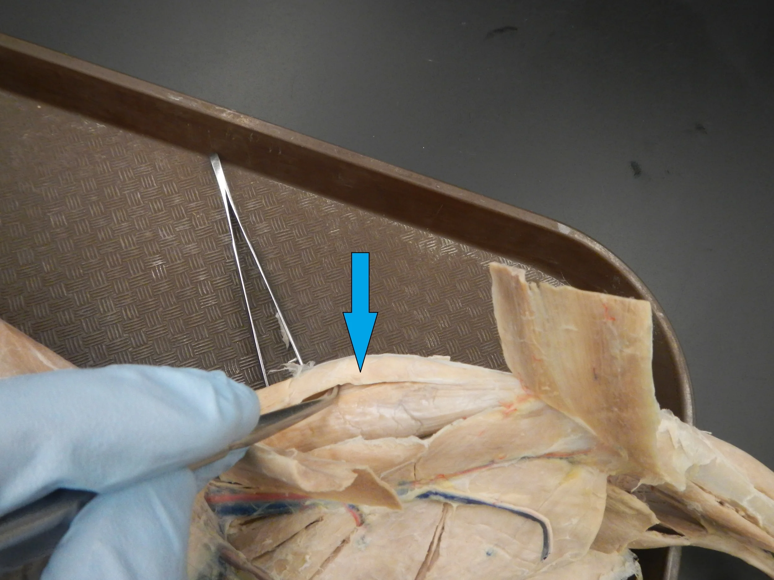 Vastus Lateralis O -
Lateral aspect of femur I -
Patella via quadriceps tendon, then tibial tuberosity via patellar tendon F -
Knee extension