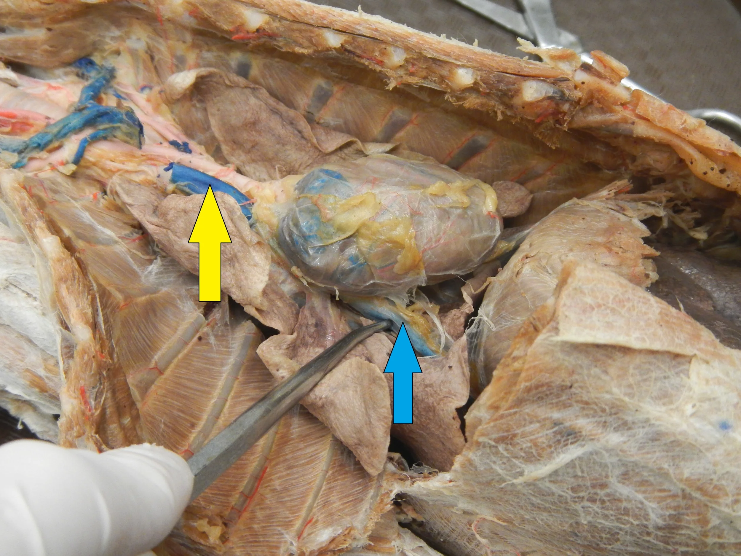 Blue - Inferior Vena Cava Yellow - Superior Vena Cava