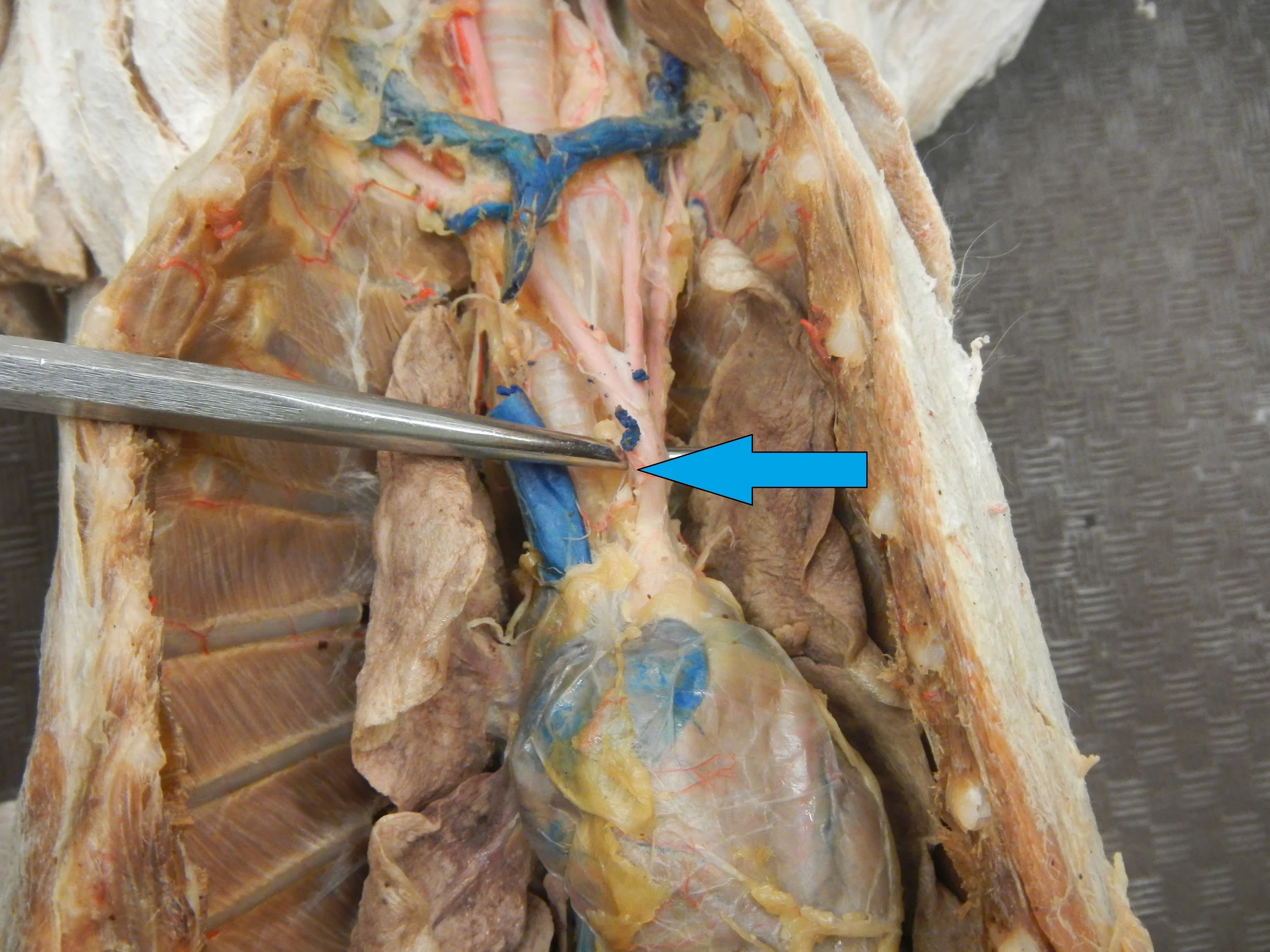 Blue - Brachiocephalic Artery