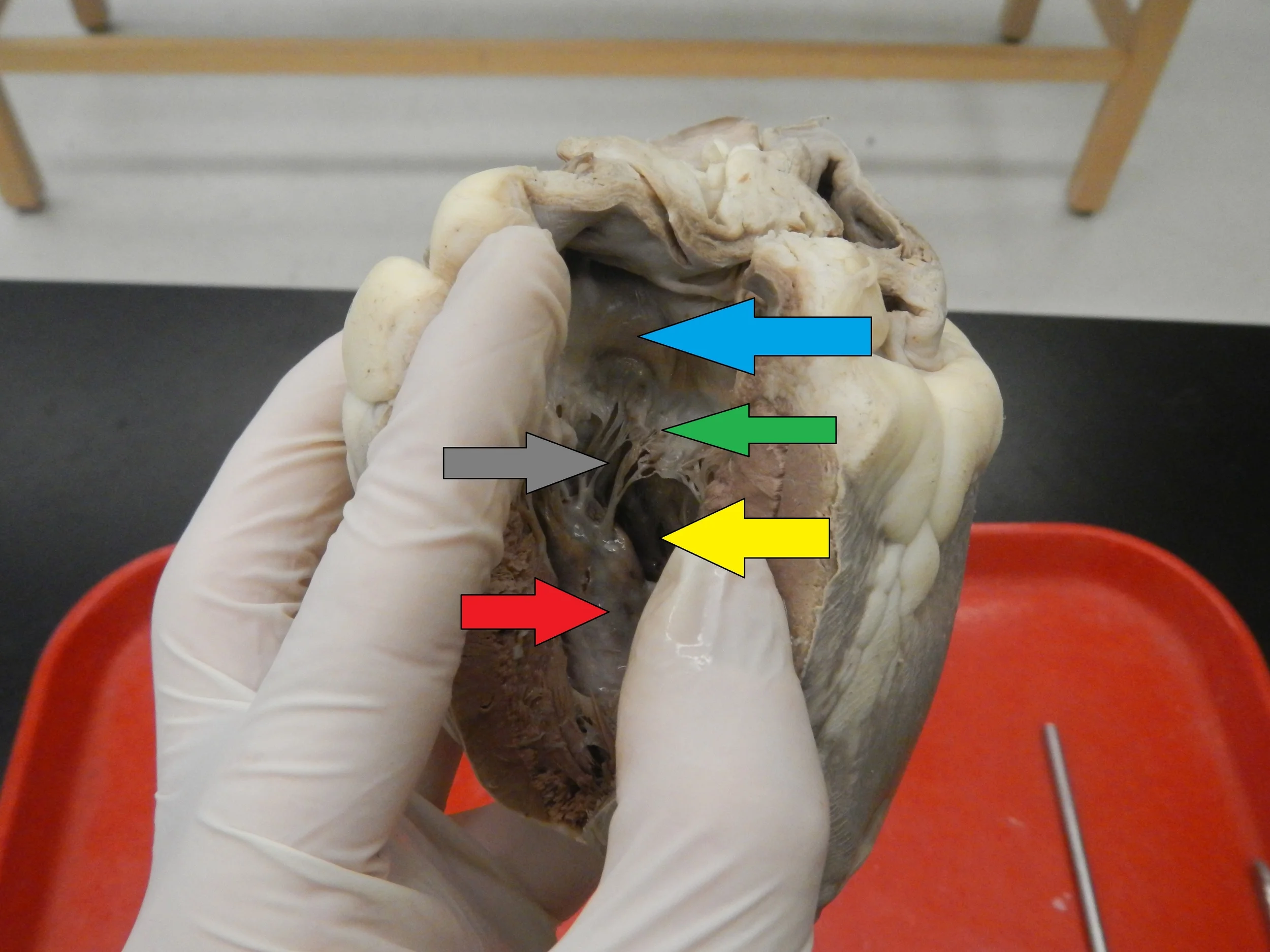 Blue - Left Atrium Green - Atrioventricular Valve - Bicuspid Grey - Chordae Tendineae Yellow - Left Ventricle Red - Papillary Muscle