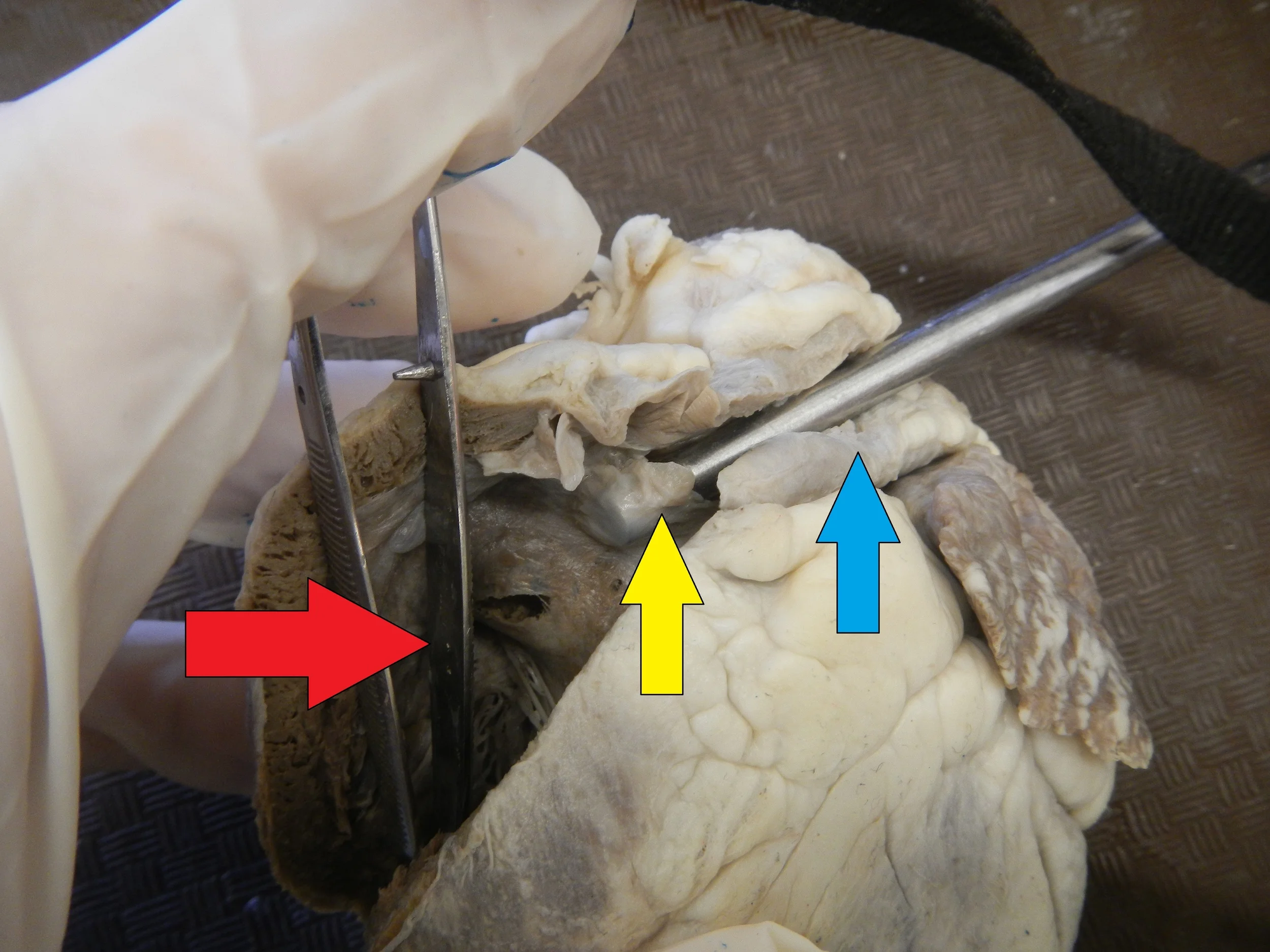 Red - Right Ventricle Yellow - Pulmonary Semilunar Valve Blue - Pulmonary Artery