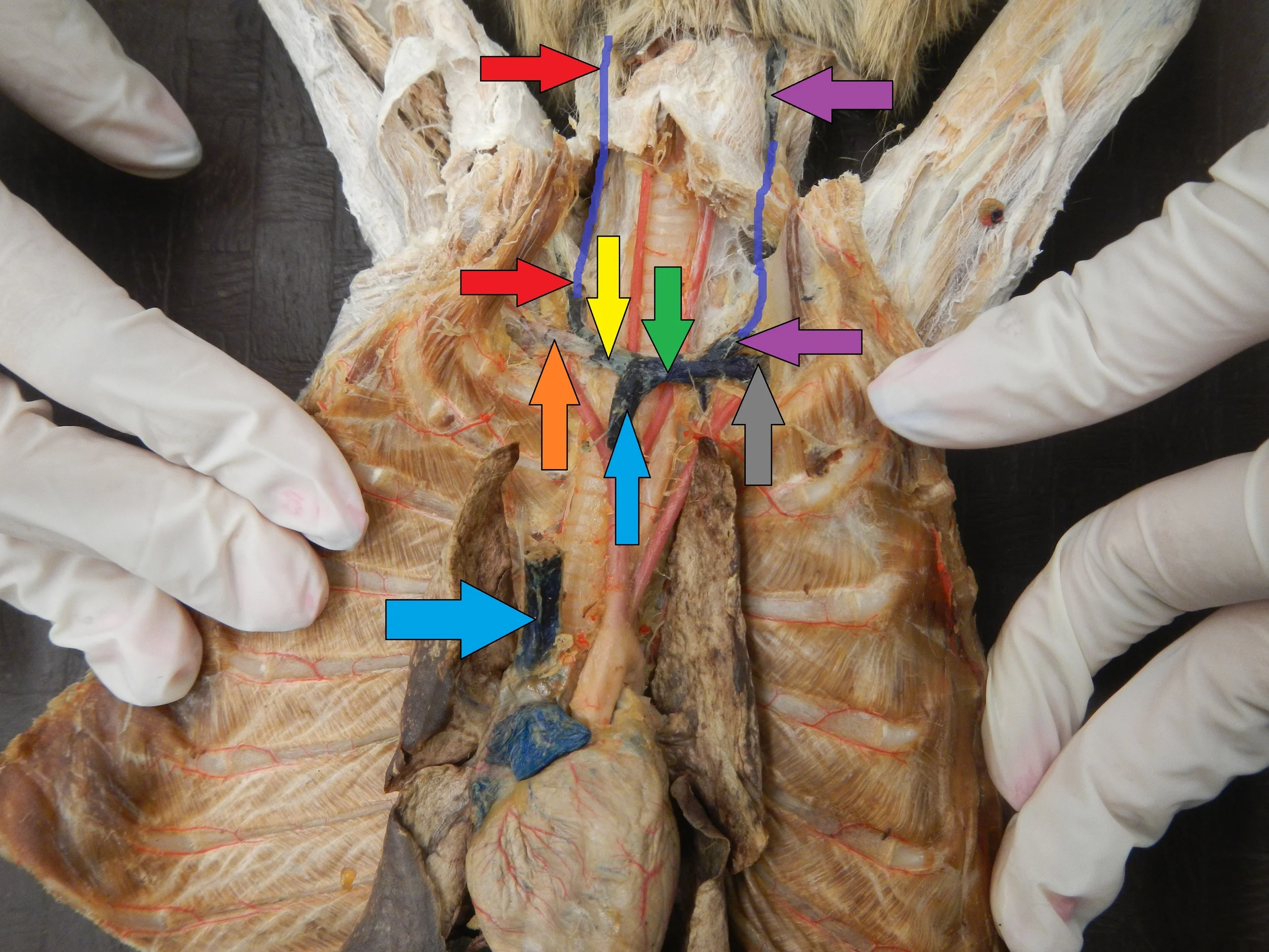 Blue - Superior Vena Cava Yellow - Right Brachiocephalic Vein Green - Left Brachiocephalic Vein Orange - Right Subclavian Vein Grey - Left Subclavian Vein Purple - Left External Jugular Vein (Continuation of vein drawn in) Red - Right External Jugular Vein ~~(Continuation of vein drawn in)