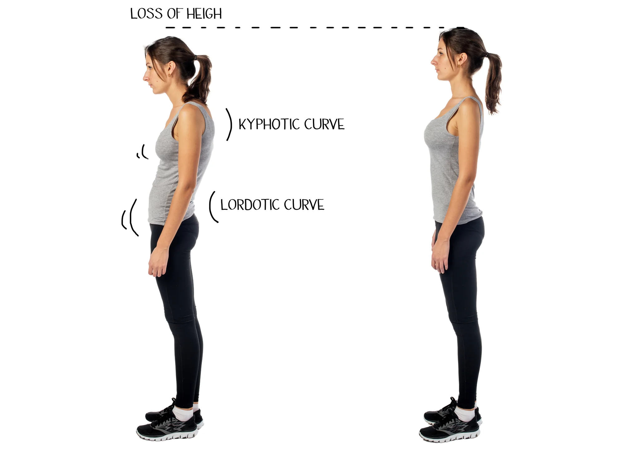Combined with strengthening exercises and myofascial stretching, Myofascial Release helps to restore better posture.