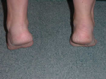 footflatfoot06.jpg