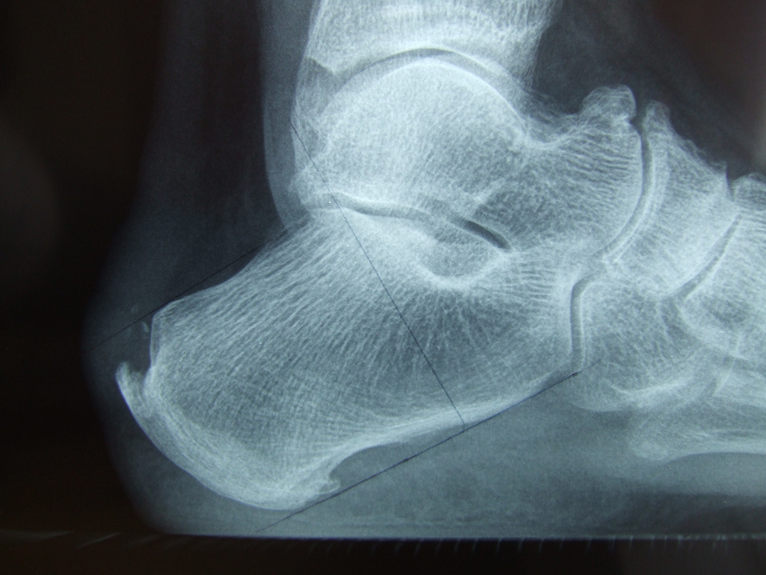 Fractures of the Heel Bone - Injuries and Poisoning - MSD Manual Consumer  Version