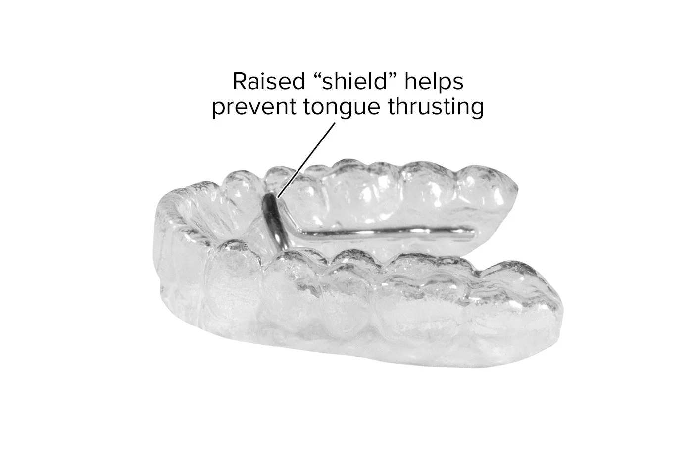 Removable Tongue Thrust Appliance – Habit Breaker Tongue Crib with Vertical Lingual Shield - At-Home