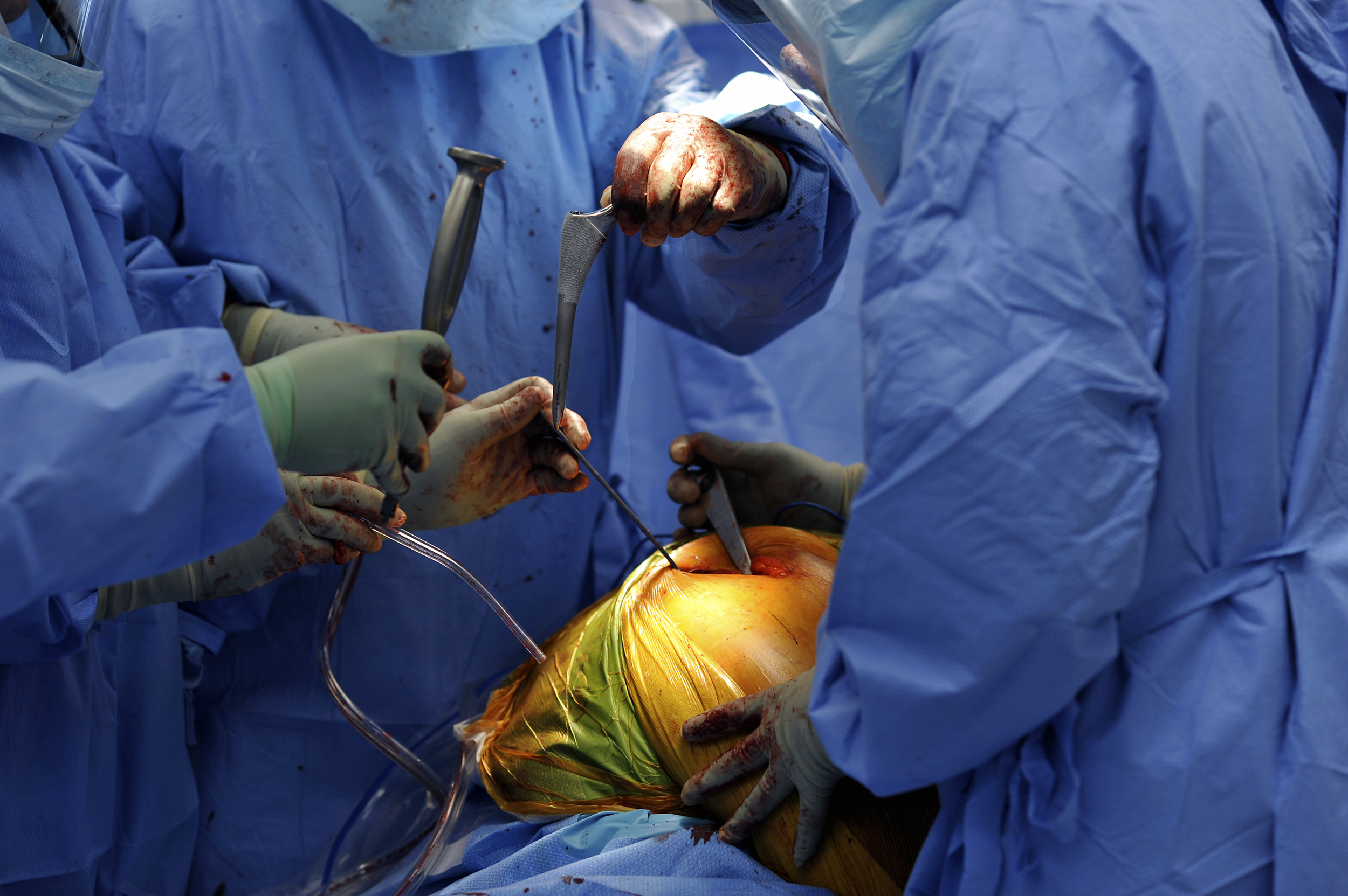 The femoral implant is about to be installed.