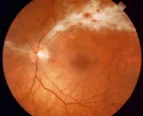 cytomega Retinitis.jpg