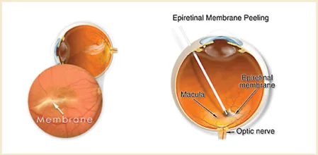 Vitrectomy Membrane Peeling