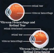 Retinal Detachment - Vitreo-Retinal Consultants