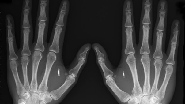 Figure 1. Amal Graafstra has two radio-frequency identification (RFID) implants. The one in his right hand was implanted by a family doctor using an Avid injector kit like the ones used on pets. He can access his front door, car door and log into his computer using his implants. (Photo courtesy of Amal Graafstra, Bellingham, United States, 2007.)