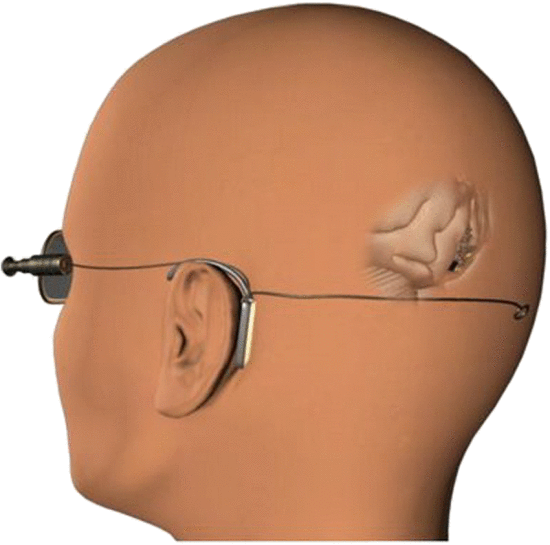 Fig. 17. Visual cortical implant designed by Prof. Mohamad Sawan, a researcher at Polystim Neurotechnologies Laboratory at the Ecole Polytechnique de Montreal (Montreal, QC, Canada). The basic principle of Prof. Sawan's technology consists of stimulating the visual cortex by implanting a silicon microchip on a network of electrodes, made of biocompatible materials, wherein each electrode injects a stimulating electrical current in order to provoke a series of luminous points to appear (an array of pixels) in the field of vision of the blind person. This system is composed of two distinct parts: the implant and an external controller. Courtesy of Mohamad Sawan 2009, made available under Creative Commons License.