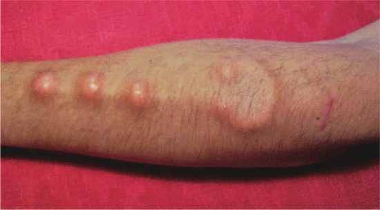 Figure 2. Spaz tacular from Germany takes a photo of a friend's implants. He notes that some weeks later, the ball in the middle of the forearm started to wander downward and got much closer to the left one. He wrote: “Sucks'cause you can't just push it back in place, you know?” (Courtesy of Spaz Tacular, 2004.)