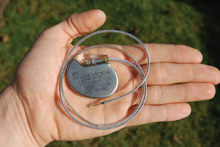 Figure 1. An artificial pacemaker (serial number 1723182) from St. Jude medical, with electrode, which was removed from a deceased patient prior to cremation. (Photo courtesy of wikimedia commons.)