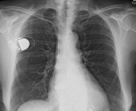 Figure 3. The conventional radiography of a single-chamber pacemaker. (Photo courtesy of wikimedia commons.)