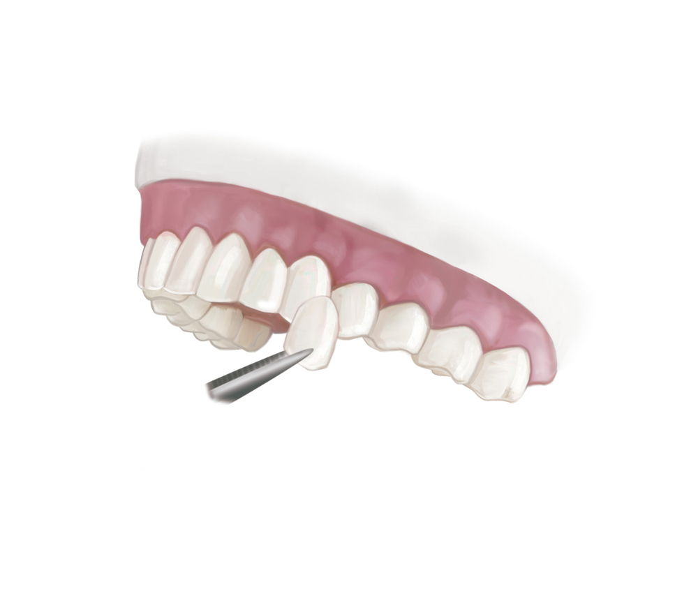 Veneer Cuffley Village.jpg