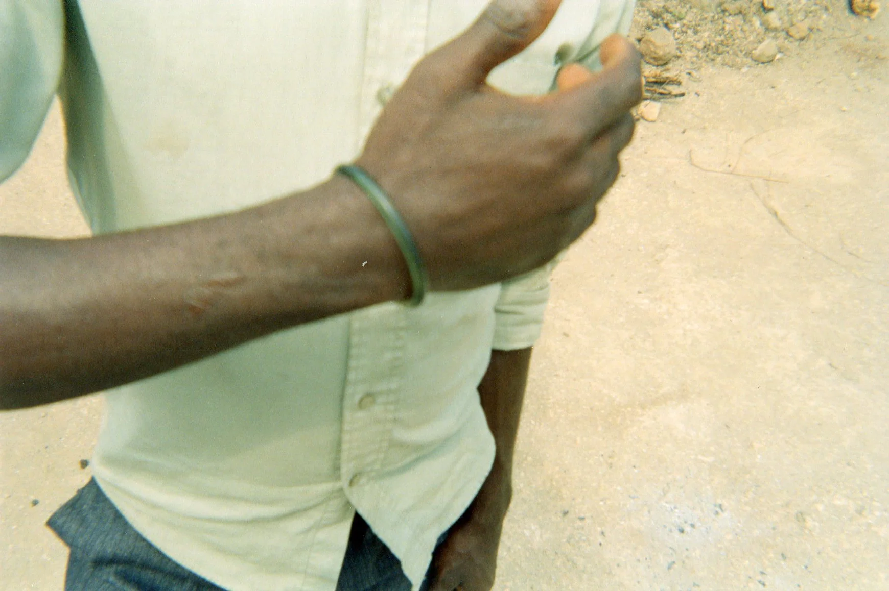 These photos show the scars I received on my arms and legs because of a grenade thrown on us during a battle when I was in an armed group. 
