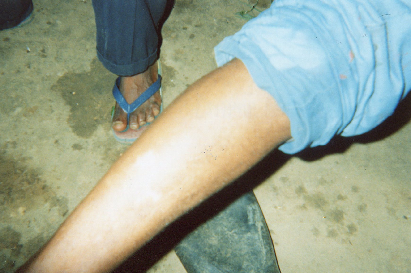  This shows the scar of Mai Mai forced to join armed groups, he was beaten a lot, also he was shot on the leg, he is unable to work.&nbsp; 