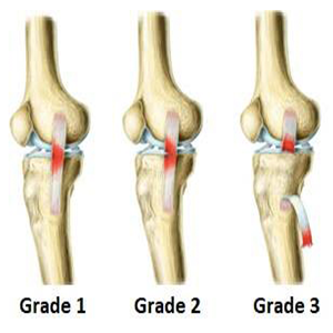 knee sprain.png