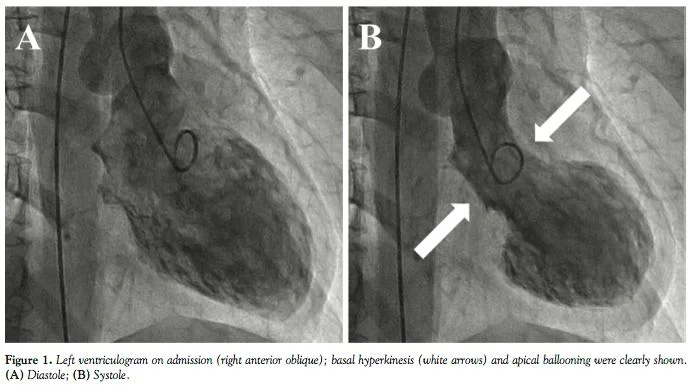 takotsubo LVgram - diastolic and systolic frames.JPG