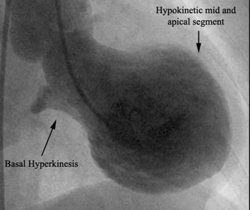 LV gram of systole in pt c Takotsubo cardiomyopathy.JPG