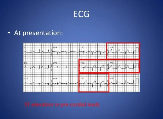 EKG in Takotsubo cardiomyopathy.JPG