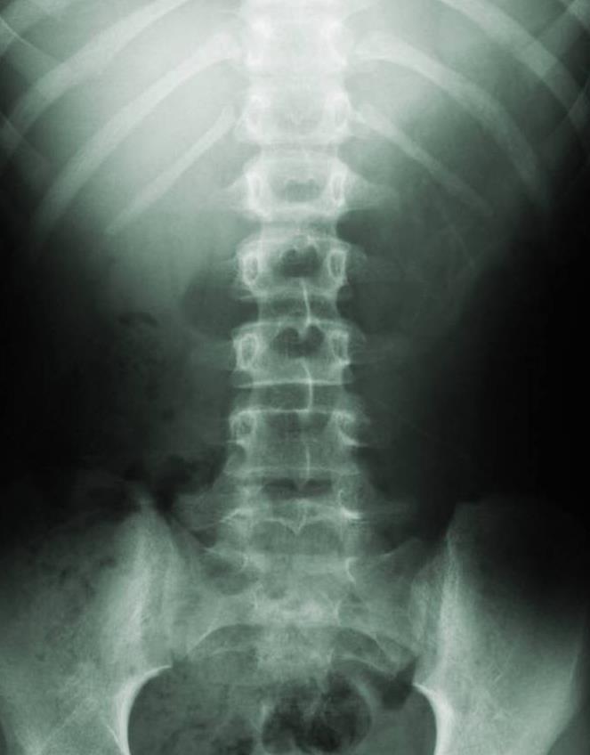spine_xray.231195817_std.jpg