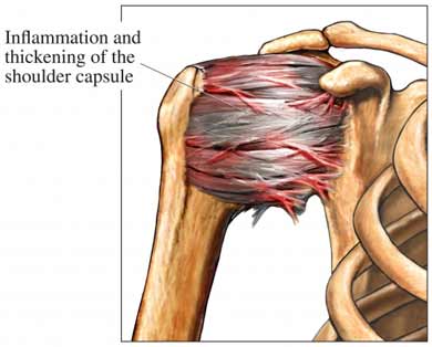 Frozen shoulder can be described as a significant reduction in range of motion of the glenohumeral (ball and socket) joint of the shoulder complex, initially caused by inflammation. As a result of this inflammation, the capsular ligaments that hold this joint together become stiff and develop adhesions which reduce the joint's active and passive range of motion. Along with the tightness/stiffness there is pain at end range of motion. 