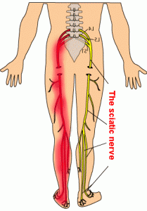 Symptoms of sciatica may include numbness, tinging, burning, sharp and/or shooting pain into the lower extremity, most often just affecting one side. 